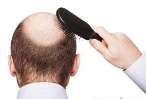 دلایل ریزش موی بهبود یافتگان کرونا
