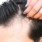 روش های درمان خشکی مو