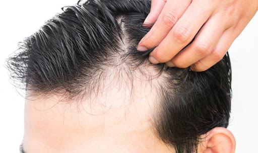 روش های درمان خشکی مو