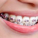 مناسب ترین سن برای ارتودنسی دندان